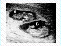 Pregnancy Stages